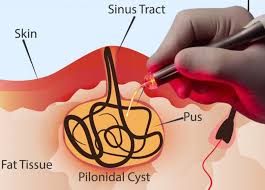 Pilonidal Sinus Treatment